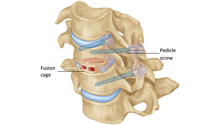 cervical spine surgery in surat, gujarat - dr sunny shethna