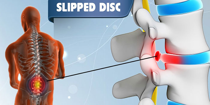 slip disc diagnosis and treatment in surat, gujarat