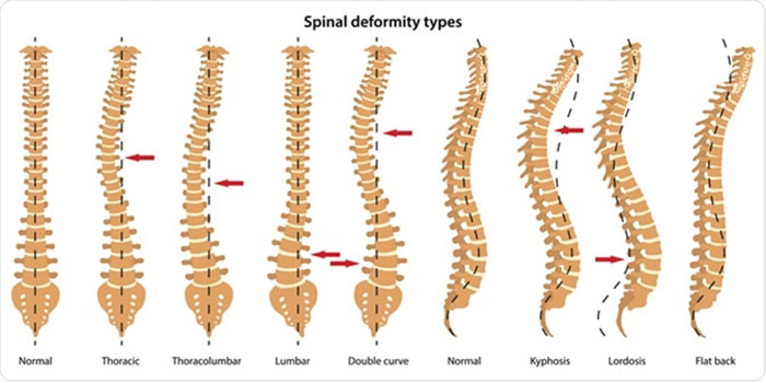 spinal deformities - causes and treatment in surat, gujarat